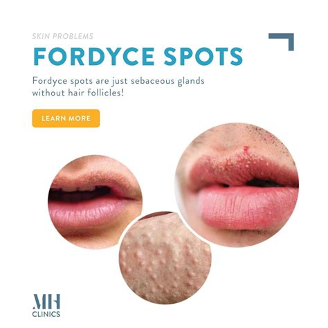 Fordyce spots